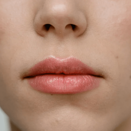 Tratamiento aumento e hidratación labial
