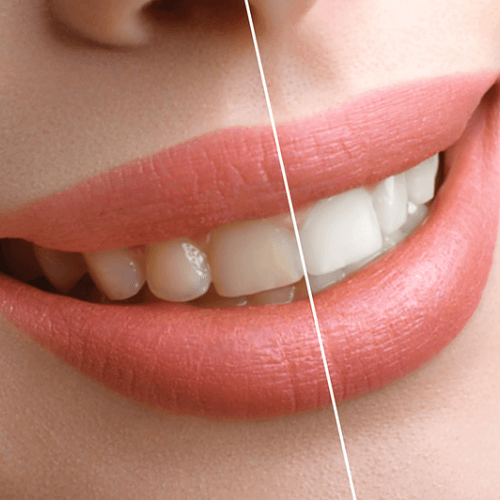 Técnicas blanquear dientes